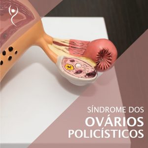 Leia mais sobre o artigo Síndrome dos Ovários Policísticos