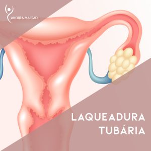 Leia mais sobre o artigo Laqueadura Tubária
