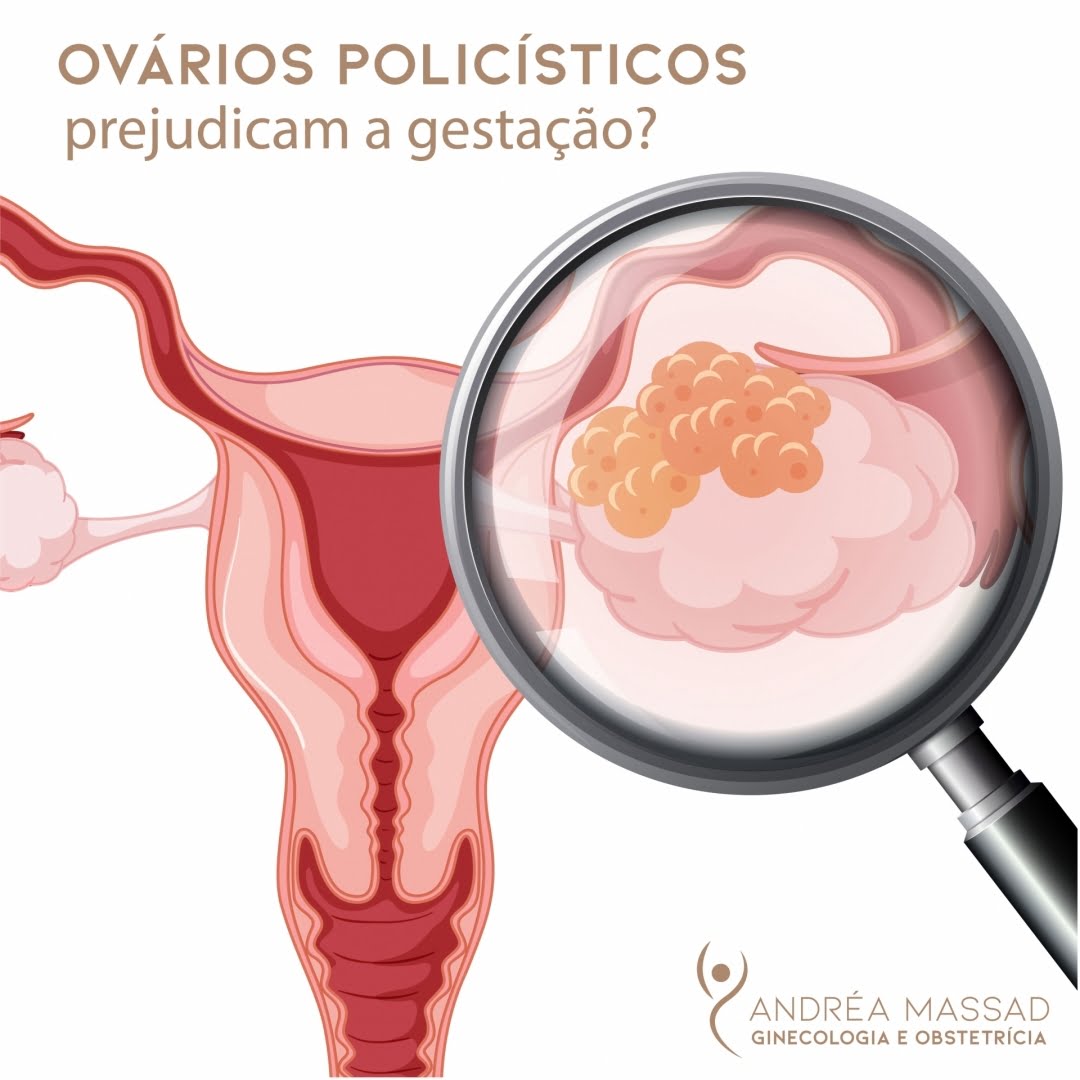 Leia mais sobre o artigo Ovários Policísticos Prejudicam a Gestação?