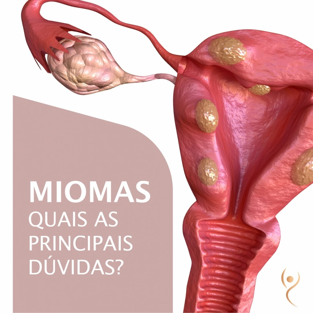 Leia mais sobre o artigo Miomas: Quais as Principais Dúvidas?
