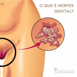 Leia mais sobre o artigo O que é Herpes Genital?