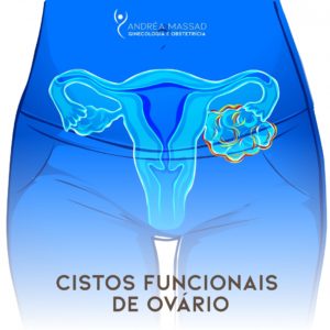 Leia mais sobre o artigo Cistos Funcionais de Ovário