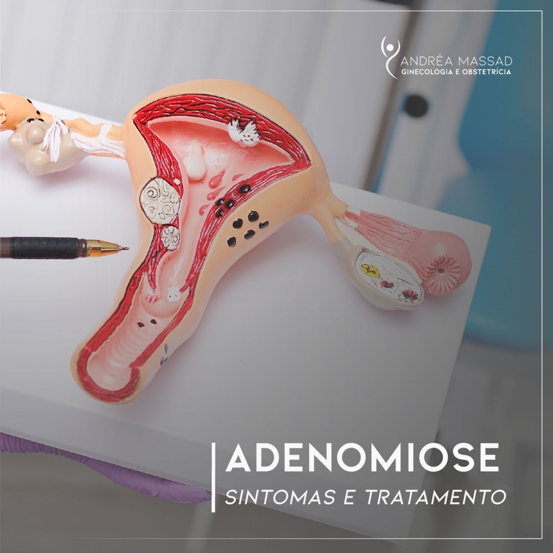 Adenomiose: conheça os sintomas