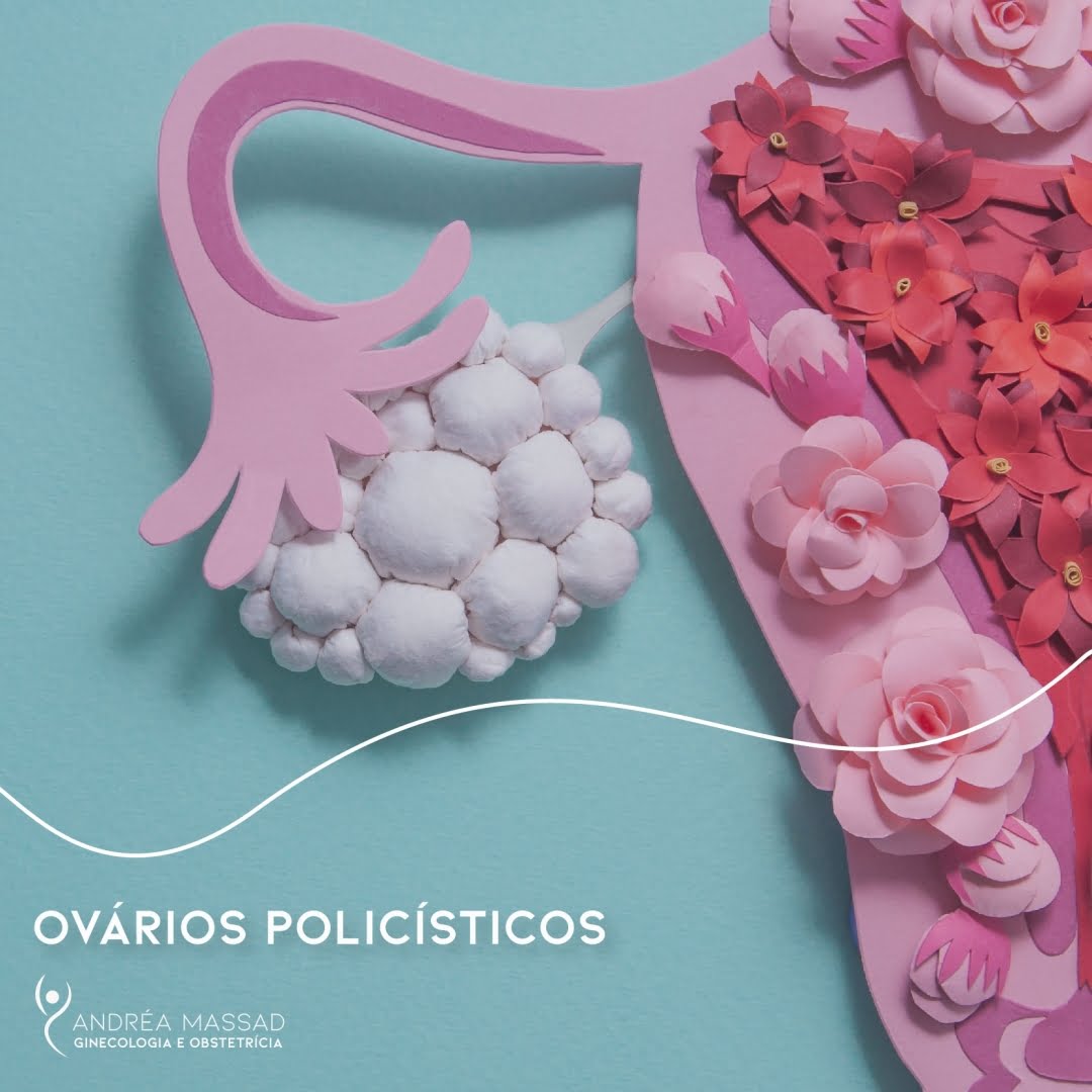 Leia mais sobre o artigo Ovário Policísticos