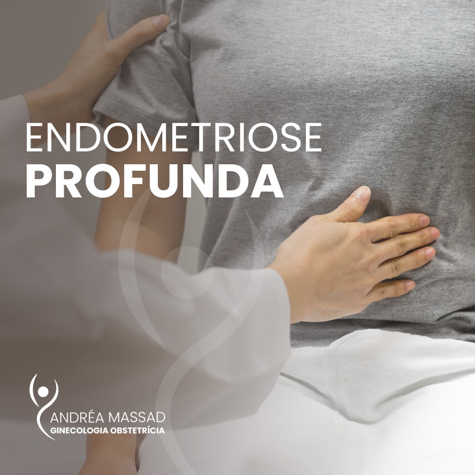No momento, você está visualizando Endometriose profunda