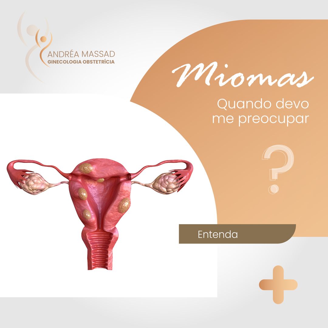 Leia mais sobre o artigo Miomas: quando devo me preocupar?