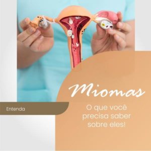 Leia mais sobre o artigo Miomas