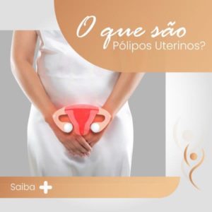 Leia mais sobre o artigo O que são Pólipos uterinos